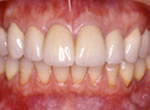 セラミックにて治療後