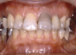 セラミックにて治療前