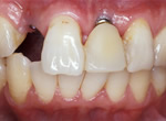 部分入れ歯からインプラントへの治療前