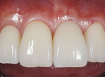 部分入れ歯からインプラントへの治療後