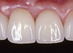 割れた前歯からインプラントへの治療後