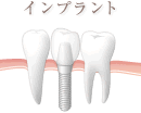 インプラント