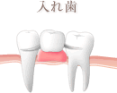 部分入れ歯
