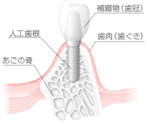 インプラントとは
