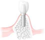 IMPLANT 鈴木歯科医院のインプラント治療