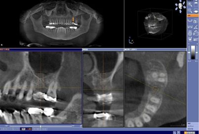 2. CT画像を用いて欠損部の解析