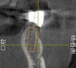 3. 撮影したCT画像を元にプランニングソフトを用いて埋入のシミュレーションを行う