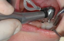 8. SICAT（サージカルガイド）を装着しオペ