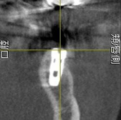 9. 埋入後の確認