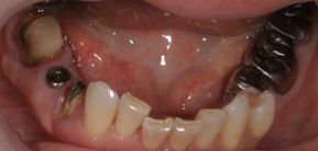 10. 2次オペ終了時