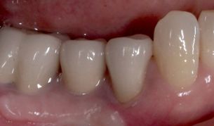 11. 理想的な埋入が行われており腫れも少なくオペが出来た